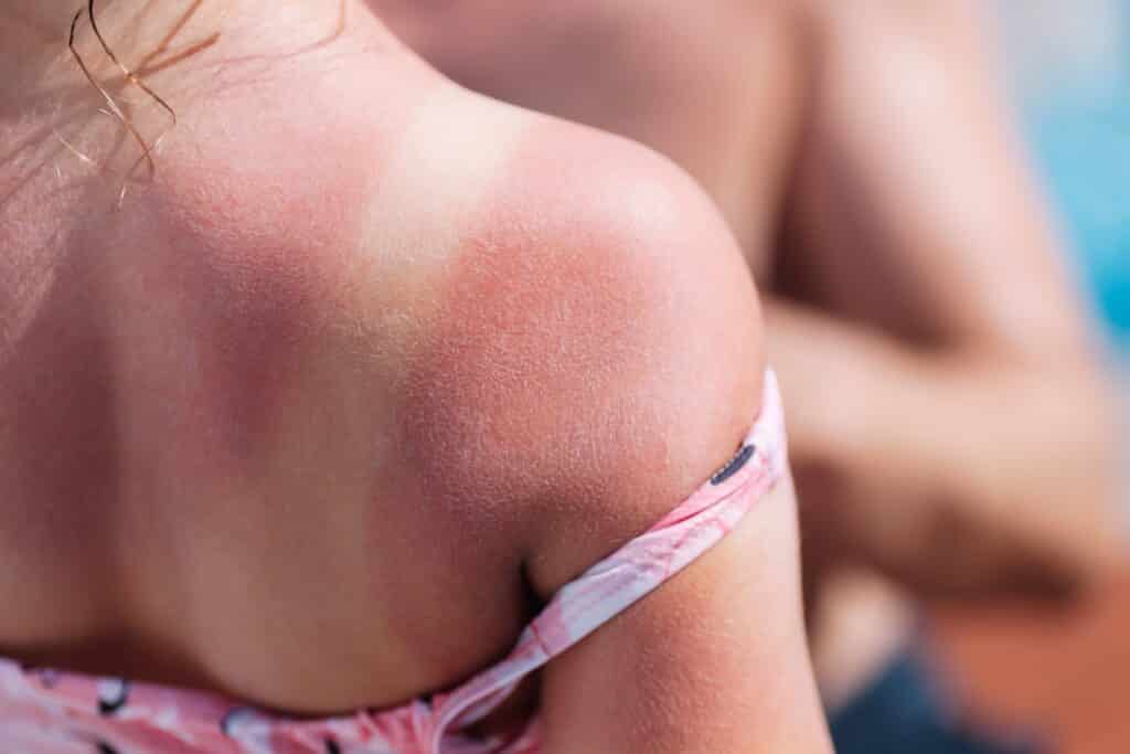 A woman with a strap of her shoulder exposing where she didn't get sunburnt.
